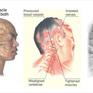 Headon Headache - How Women Can Overcome Migraine?