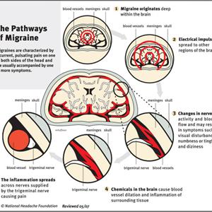 Vascular Migraine Headaches - Migraine Headache Treatment, Ways To Treat Migraine Headache